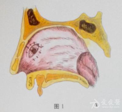 耳鼻咽喉头颈外科手术征集——鼻中隔穿孔修补术