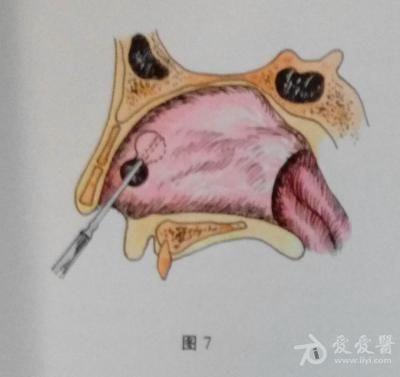 耳鼻咽喉头颈外科手术征集——鼻中隔穿孔修补术