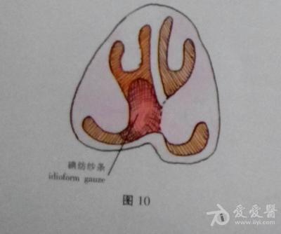 【适应症】 由外伤,手术,鼻中隔慢性炎症性溃疡,或工业废气侵蚀所引起