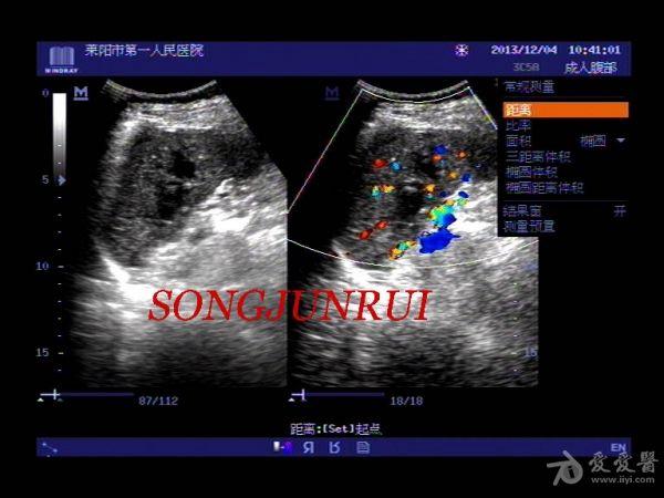 超声入门贴305-----脾破裂