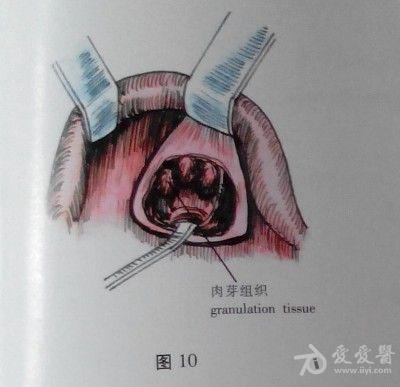 耳鼻咽喉头颈外科手术征集——上颌窦根治术