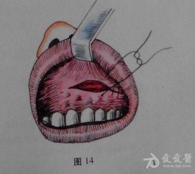 耳鼻咽喉头颈外科手术征集——上颌窦根治术
