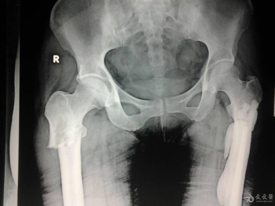 楼主恒康斌斌2013-12-08 20:16:00 患者,女性,49岁,因"外伤致右髋部