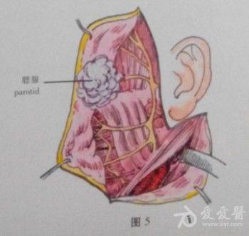 鼻咽癌腮腺淋巴结转移临床分析