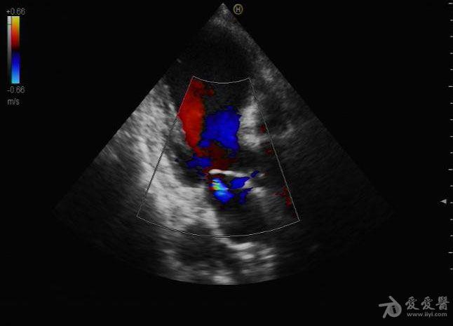 心尖部室壁瘤 - 超声医学讨论版 - 爱爱医医学论坛