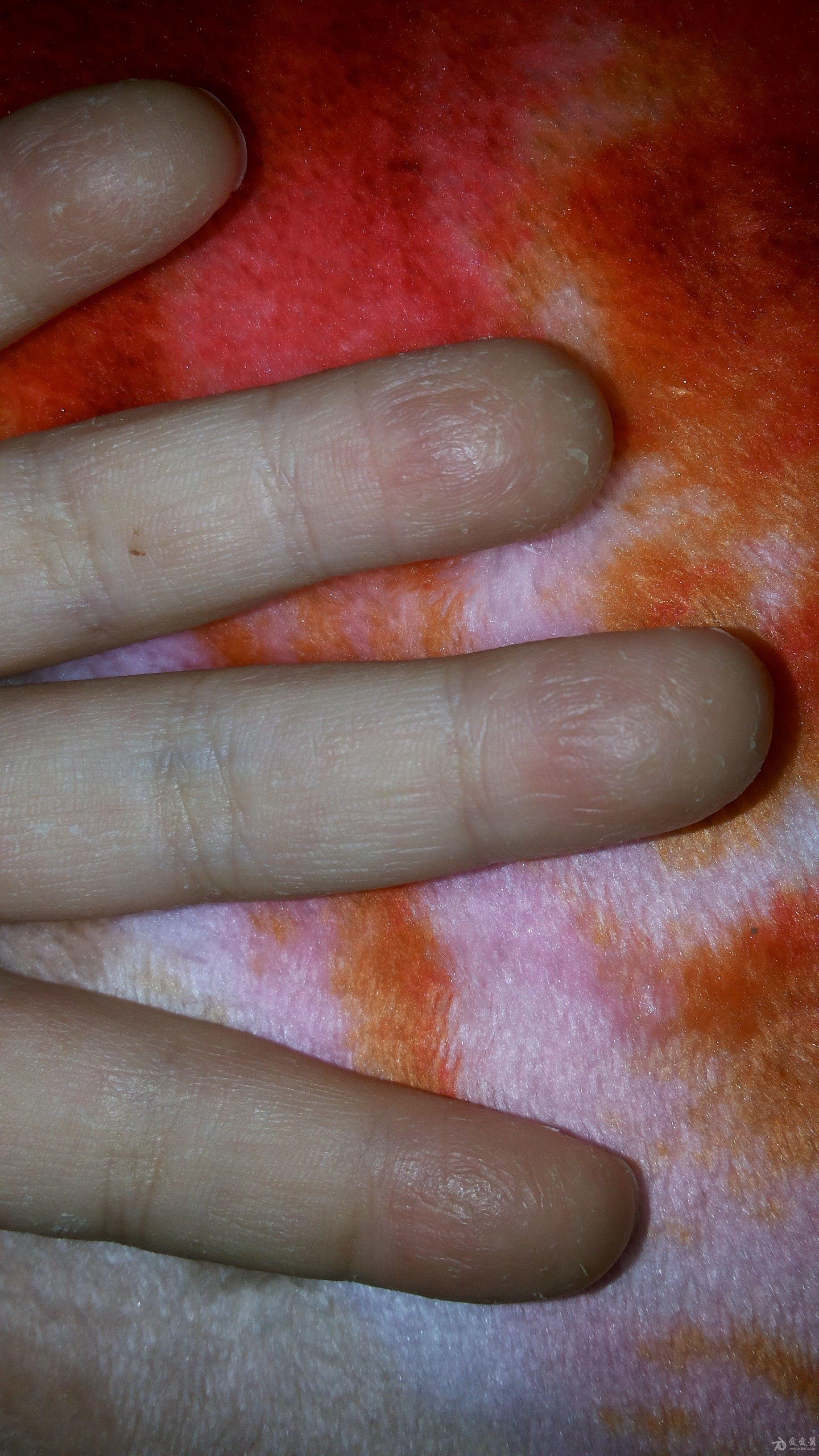 小儿手指脱皮伴轻微痒一个月 - 皮肤及性传播疾病讨论
