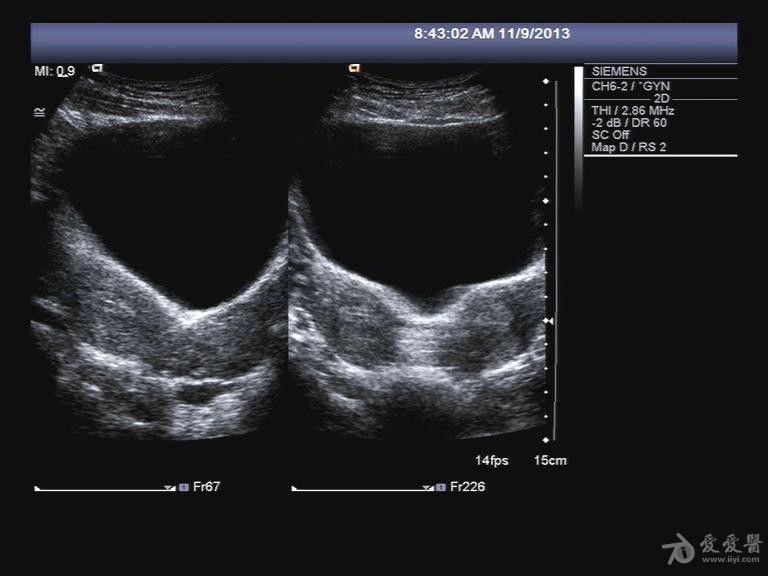 典型病例:双子宫单宫颈单阴道 - 超声医学讨论版 - 医