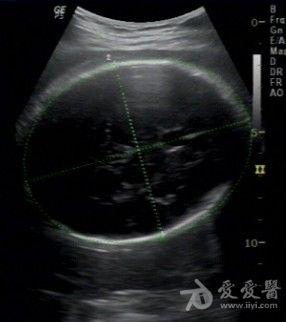 双顶径两个图 哪个标准 - 超声医学讨论版 - 爱爱医