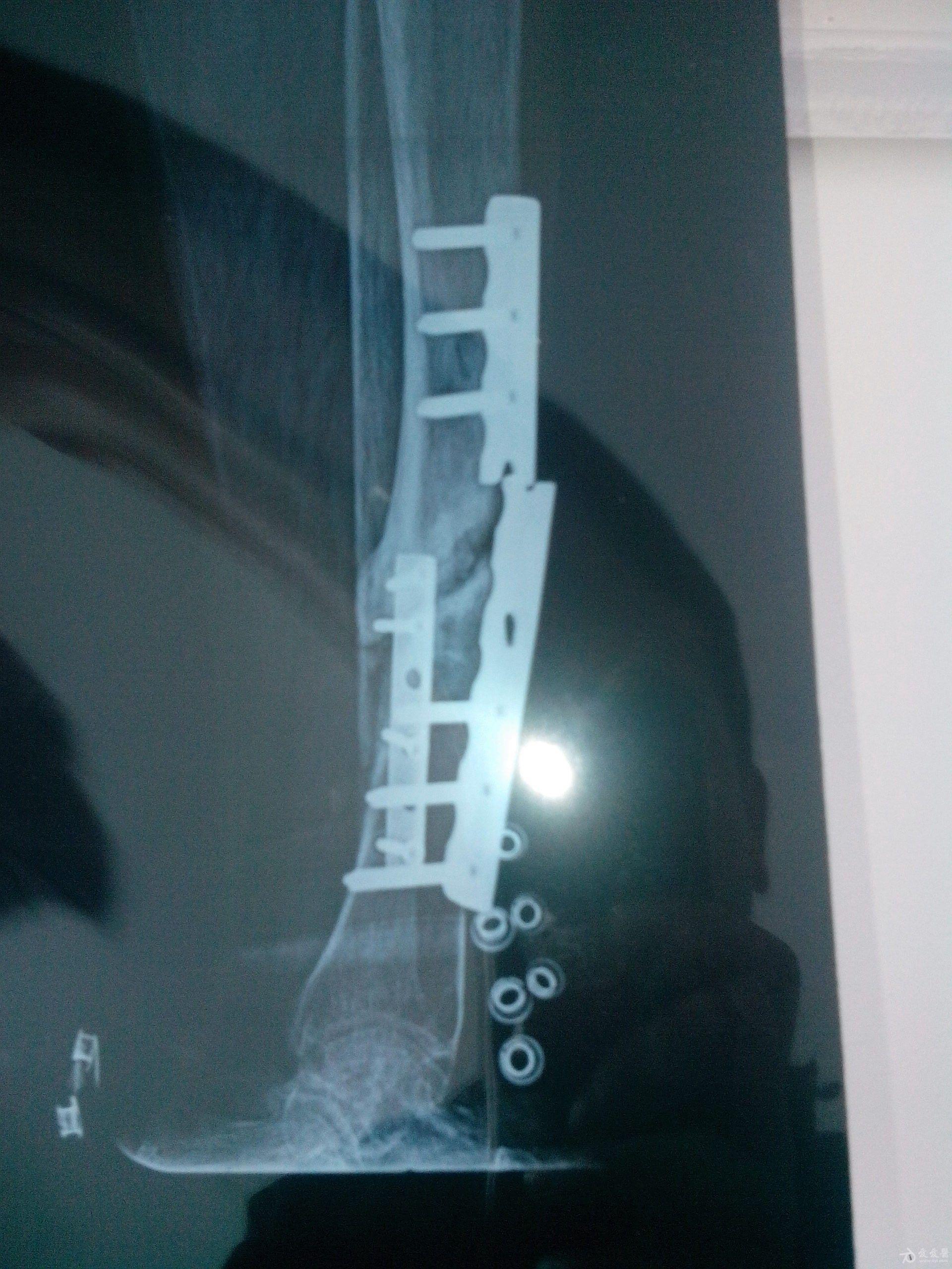 于是复查x片后发现,胫骨固定钢板断裂,去当初做手术的医院检查后