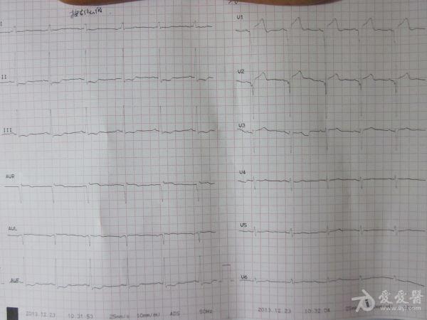 年轻患者,多导联异常q波,请老师帮忙看看 心电图脑电图专业讨论版