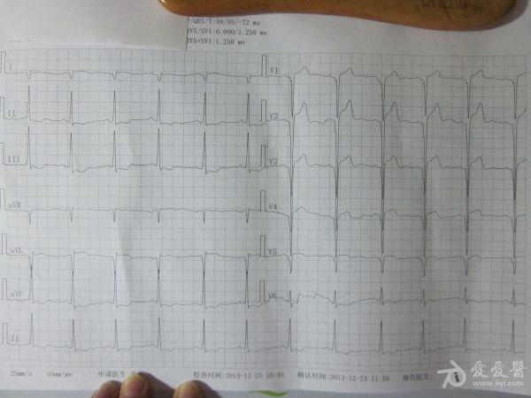 年轻患者,多导联异常q波,请老师帮忙看看