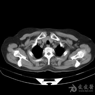 永存左上腔静脉直接引流入左心房.