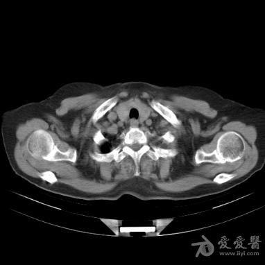 永存左上腔静脉直接引流入左心房.