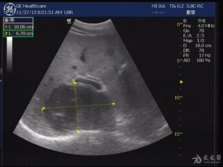肝内低回声团块,肝脓肿(介入治疗康复 超声医学讨论版 爱爱医