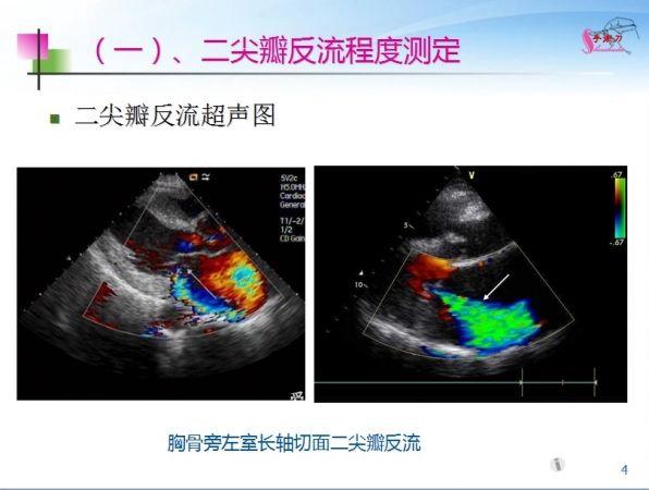 图解超声心动图评估瓣膜反流与狭窄 - 超声医学讨论版 - 爱爱医医学