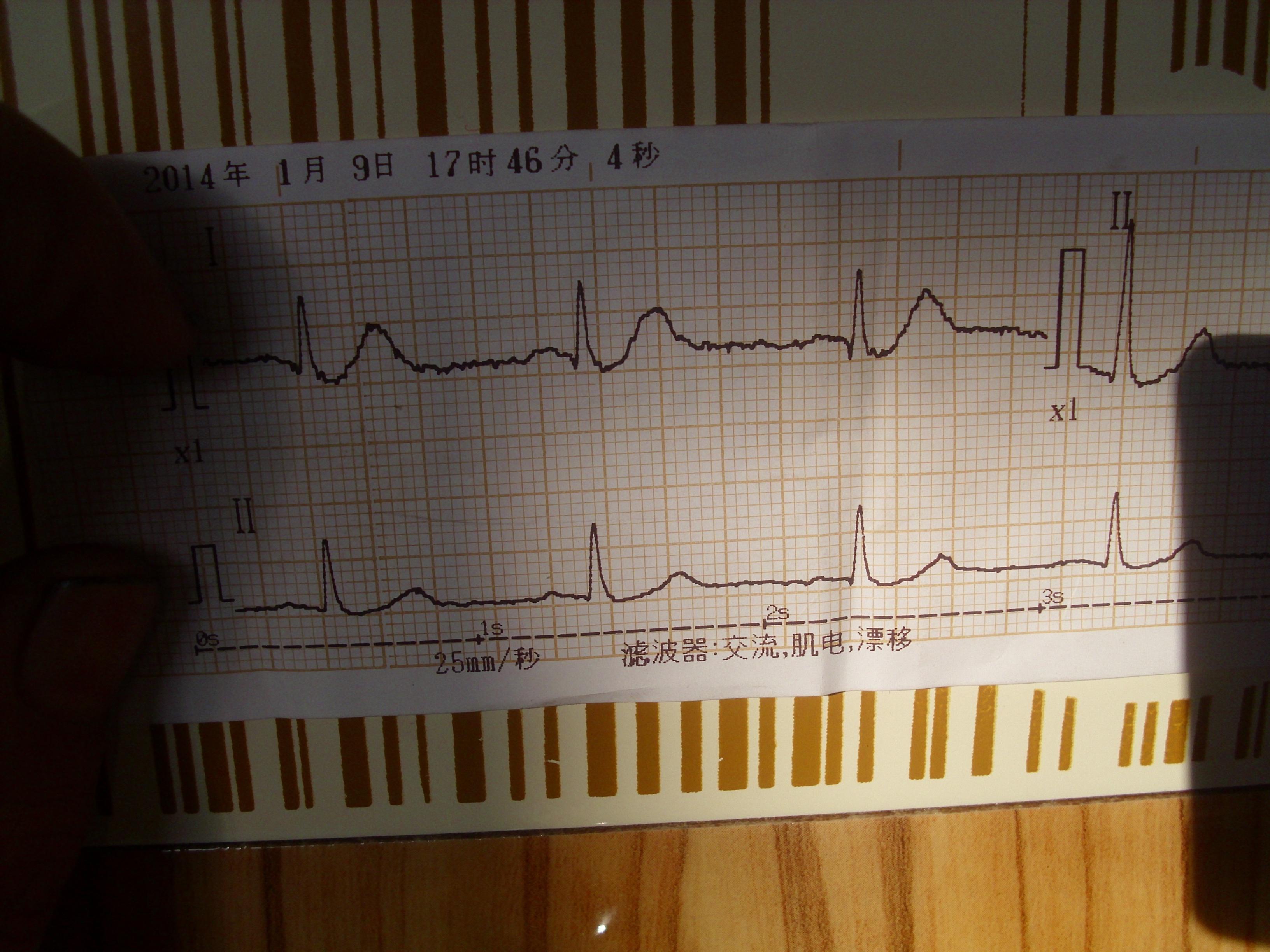 一例典型的心电图,请大家看看是不是心梗超急性期