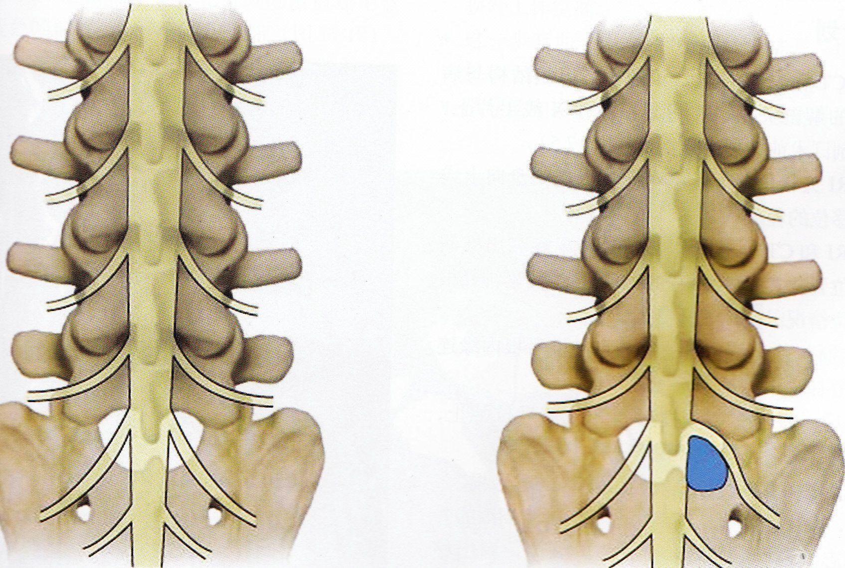 应用脊柱内窥镜经椎板间隙入路治疗腰椎间盘突出症一例报告(椎间孔镜