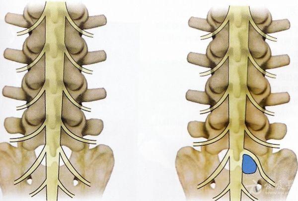 l5/s1 骨科与显微外科专业讨论版 爱爱医医学论坛 爱爱医医