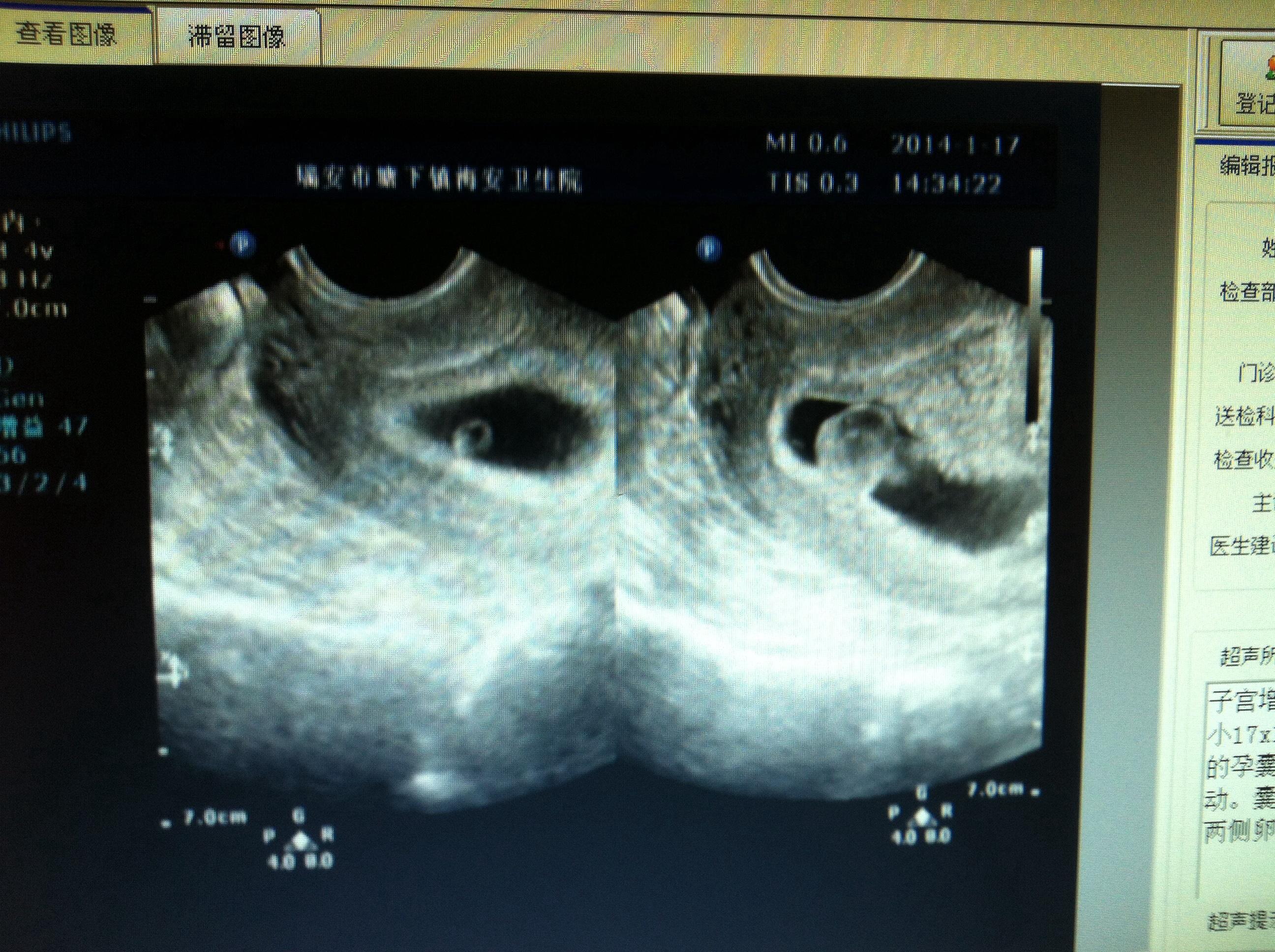 09:32:57b超显示孕囊大小约46x28x41mm,可见卵黄囊及胎芽长约5mm,见