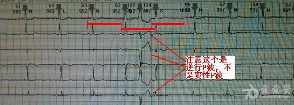 心电图讨论