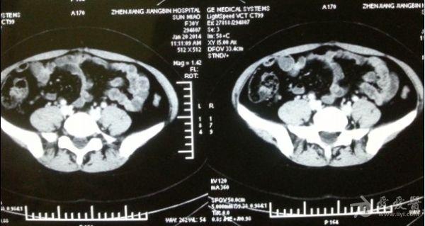 相隔半年的ct和核磁的盲肠系膜淋巴结有没变大啊