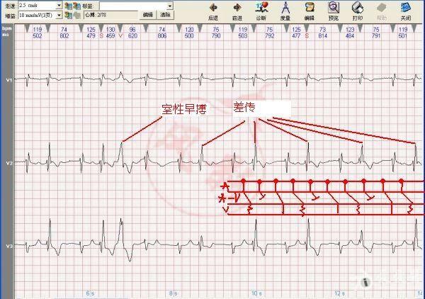 1,窦性心律 2,ii度i型房室传导阻滞(p-r逐渐延长,直至脱落)3,肢导低