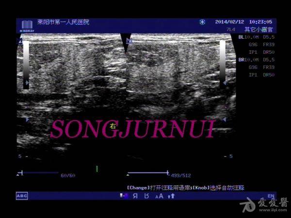 超声入门贴338-罕见病例《马德龙病,俗称海马脖(有体表图,超声