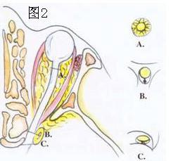 耳鼻咽喉头颈外科手术征集——经筛窦视神经减压术