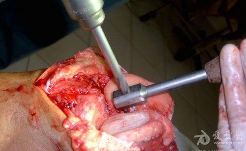 膝关节置换 手术图片 - 骨科与显微外科专业讨论版