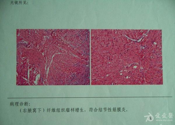 2年半年后原部位再次发现肿物,复查病理片修正诊断为韧带样纤维瘤.