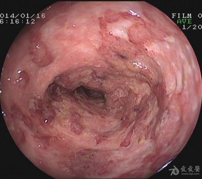 腹痛腹泻脓血便2月,行肠镜检查,请各位老师帮读片