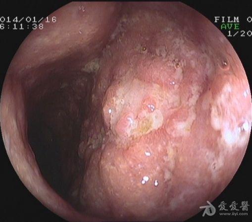 腹痛腹泻脓血便2月,行肠镜检查,请各位老师帮读片