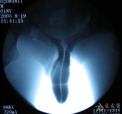 后侧弯3年     【现病史】患者三年前偶然发现阴茎勃起时向左侧弯曲