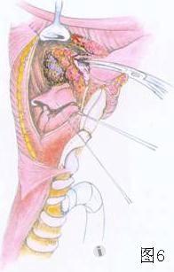 cancer with preservation of laryngeal function     在解剖上,下