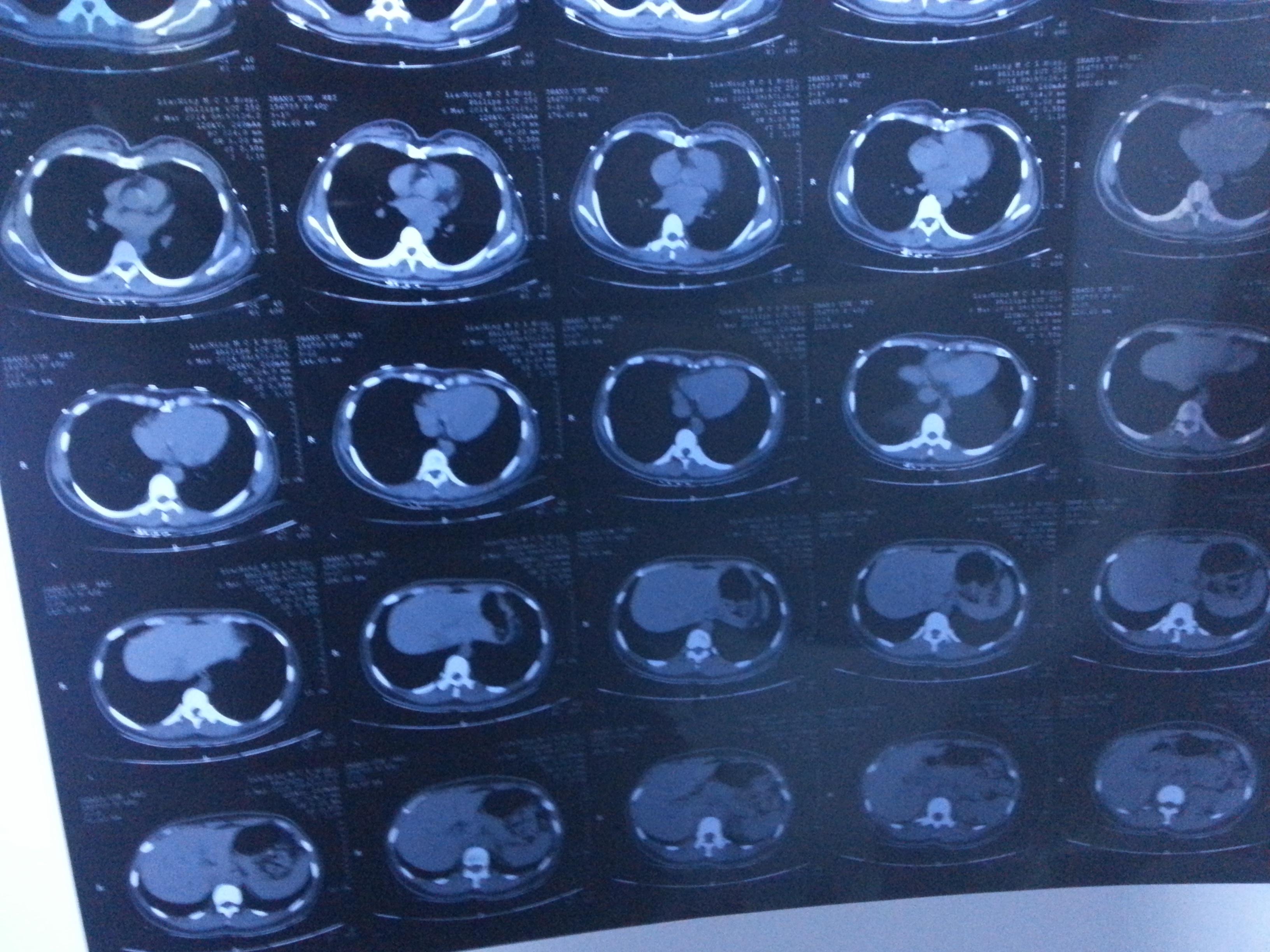 罕见肺部恶性颗粒细胞瘤的影像表现_医学界-助力医生临床决策和职业成长