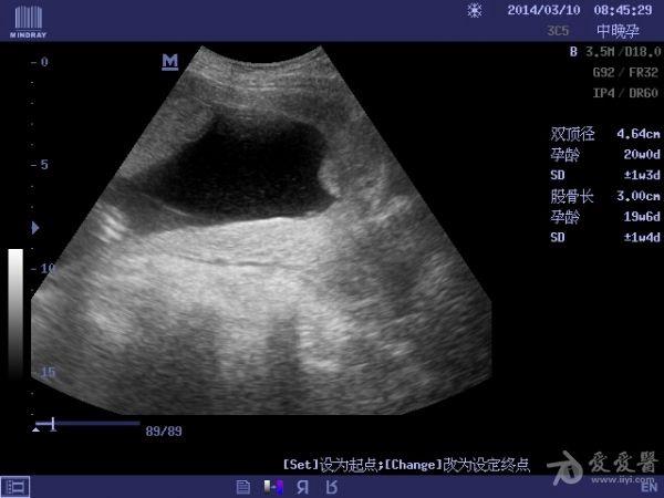 孕5月,副胎盘? - 超声医学讨论版 - 爱爱医医学论坛