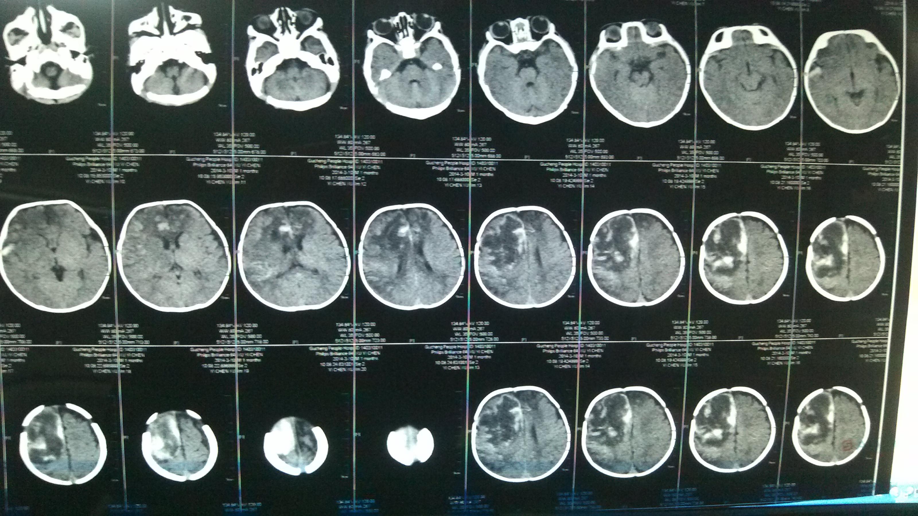 帮我看下脑出血的ct片子
