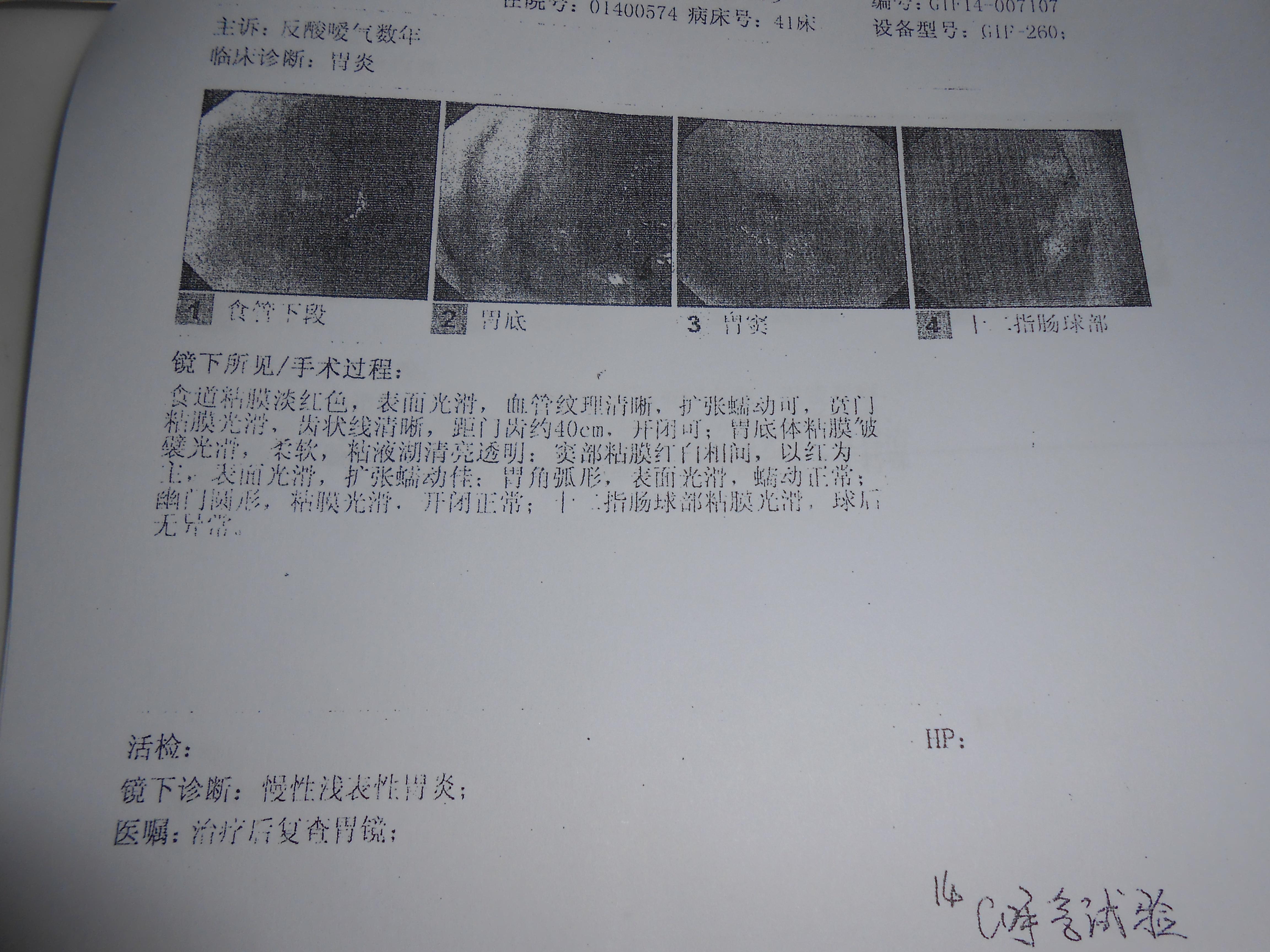 反复腹胀不适,初步考虑慢性胆囊炎,近期复查发现cea略