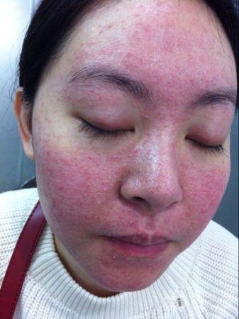 患者女25岁,皮疹反复十余年,发作时轻痒,面部发热明显