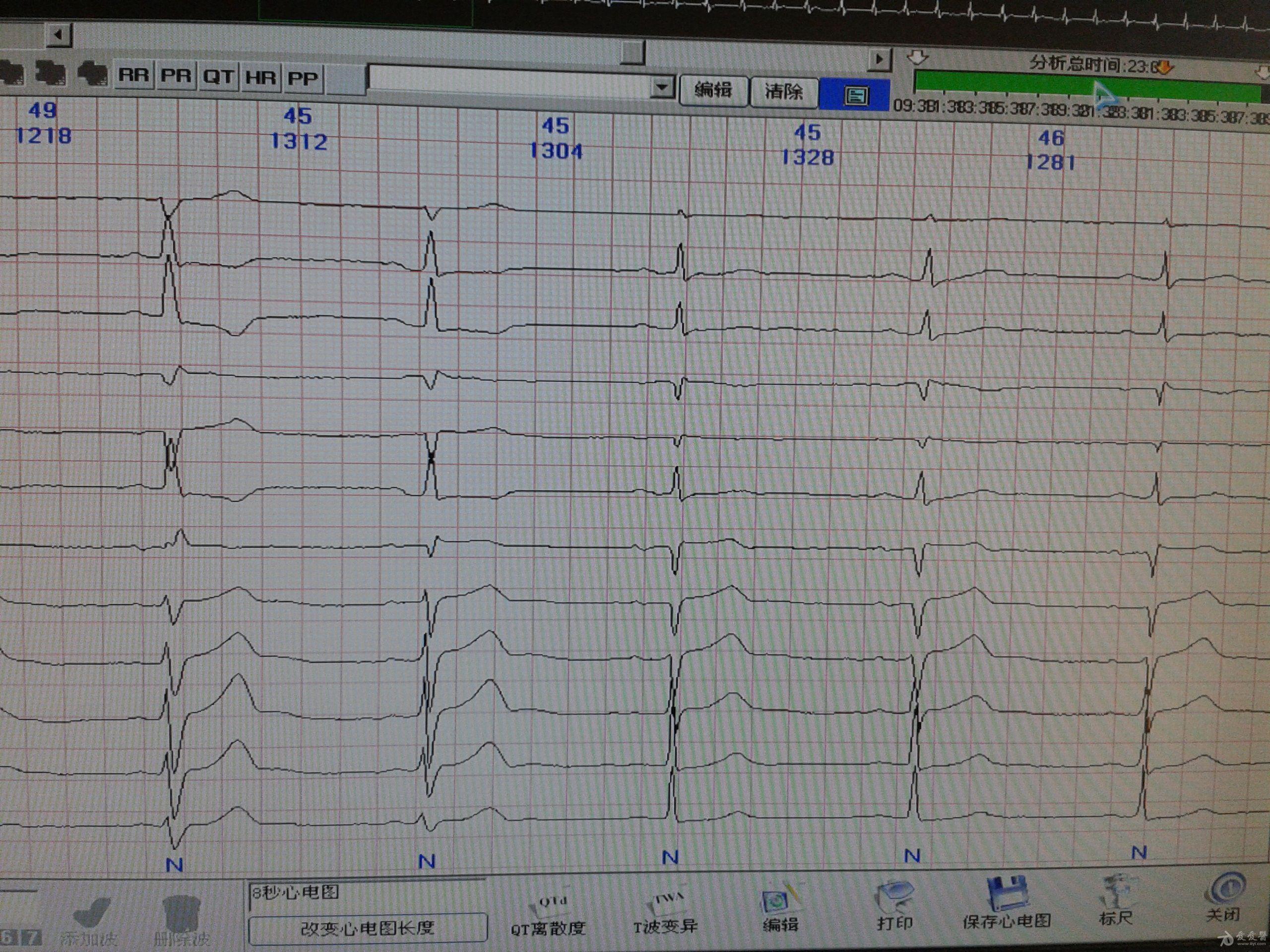这组图是房室分离,室性逸搏还是室速? - 心电图脑电图