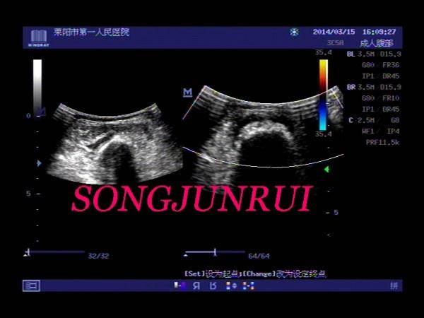 超声入门贴351-----股骨骨软骨瘤(超声图 x线表现)