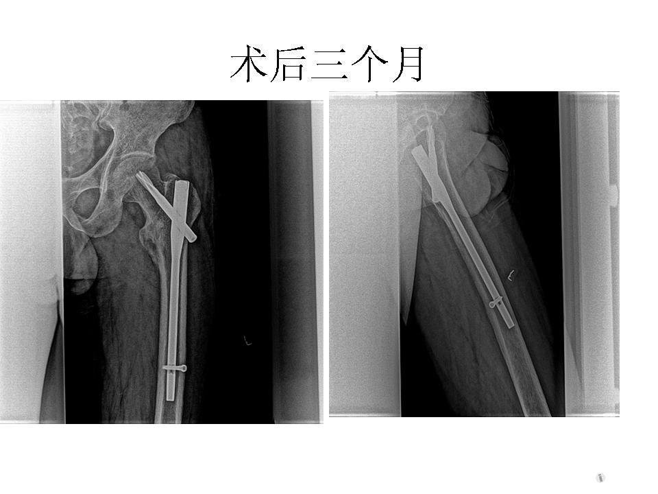 股骨粗隆间骨折【55期读片会课件与录音发表】