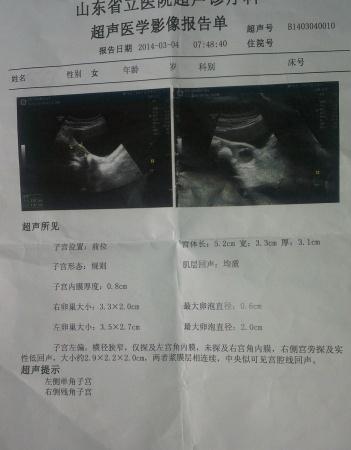 左侧单角子宫合并右侧残角子宫