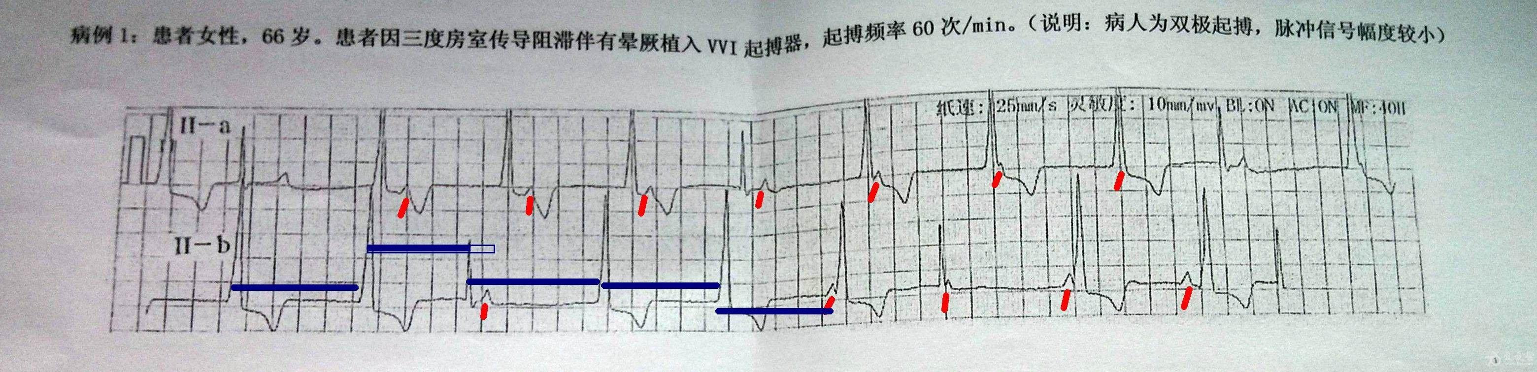 请教一下这四例起搏器心电图