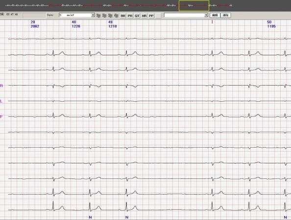 各位老师看看分析为窦房阻滞对吗 心电图脑电图专业讨论版 爱爱医