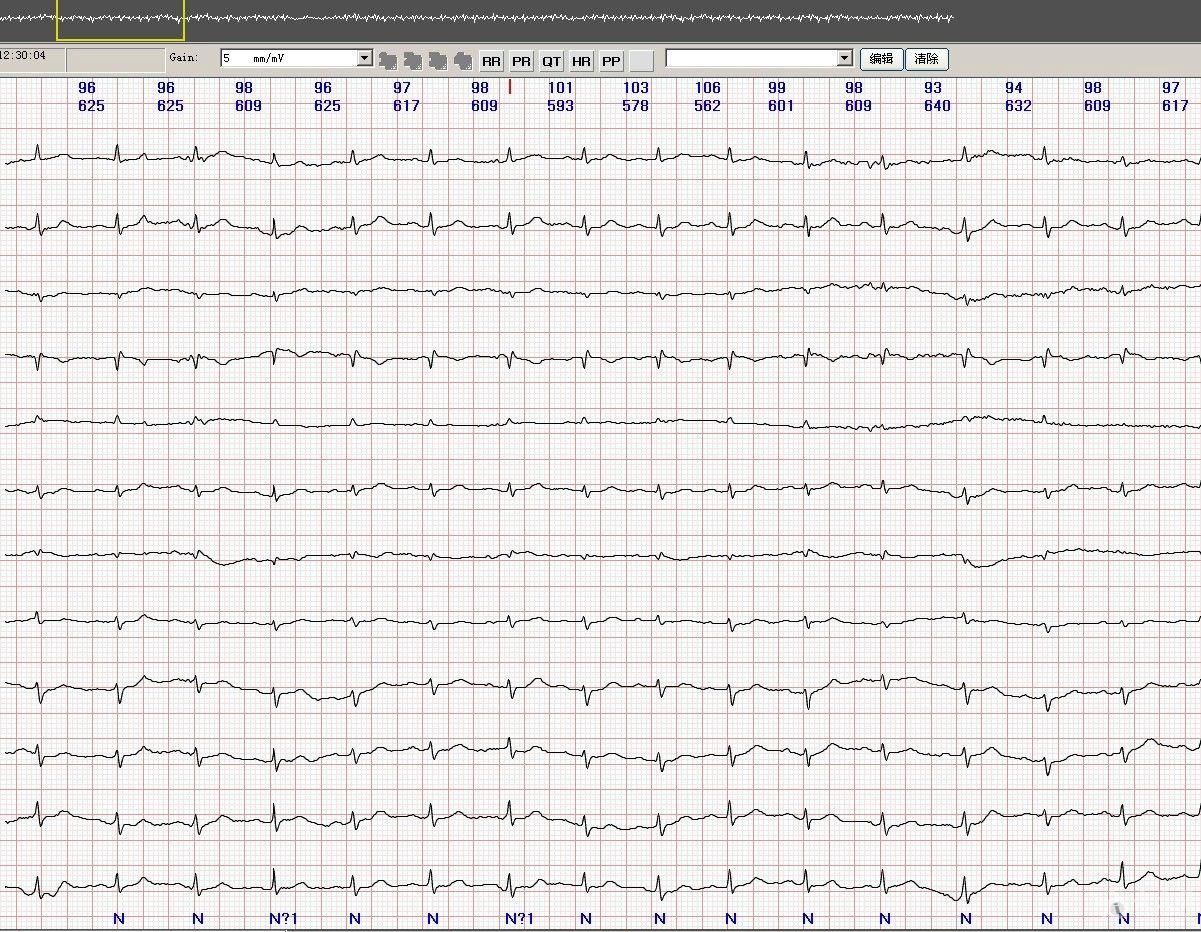 各位老师看看分析为窦房阻滞对吗 心电图脑电图专业讨论版 爱爱医