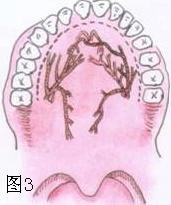 耳鼻咽喉头颈外科手术征集——鼻咽血管纤维瘤切除术