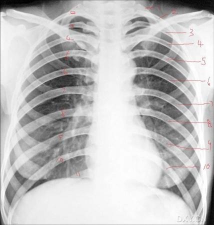 要想读好胸片首先要知道正常胸片是怎样的,总的来说可以用以下的文字