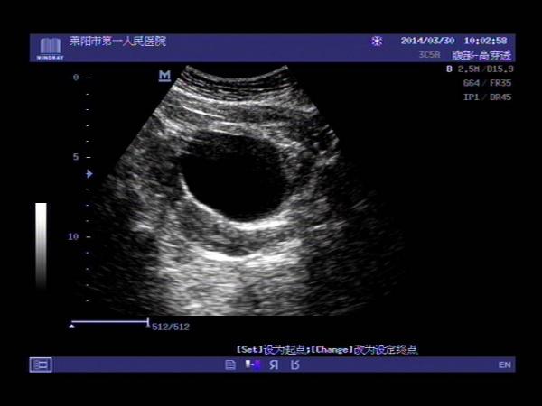 超声入门贴364-----卵巢冠囊肿