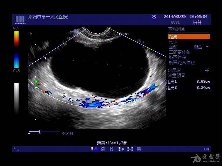 超声入门贴364-----卵巢冠囊肿